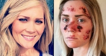Tawny Willoughby was diagnosed with skin cancer at 21, wants you to stop using tanning beds