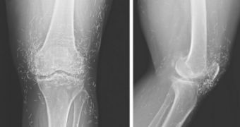 The X-rays showing the hundreds of needles in the woman's knees