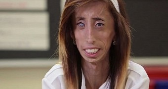 Lizzie Velasquez is 26 years old and suffers from 2 rare conditions, but she remains a fighter