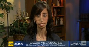 Lizzie Velasquez has been diagnosed with a rare condition, has no adipose tissue