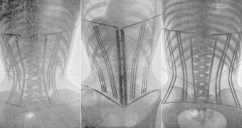X-Rays Show That Women Would Destroy Their Rib Cages due to Corsets