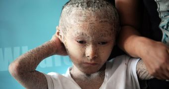 “Fish Boy” suffers from Ichthyosis