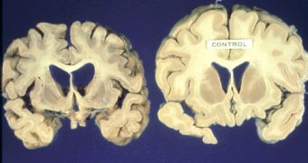 Left: brain of HD patient; right: normal human brain (sections)