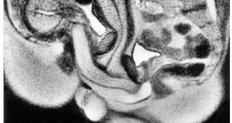 MRI image of a sexual intercourse