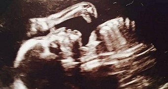 Dinosaur silhouette appears in baby scan