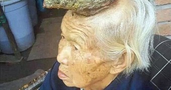 Woman Has 13-Centimeter (5-Inch) Horn Growing on Her Forehead