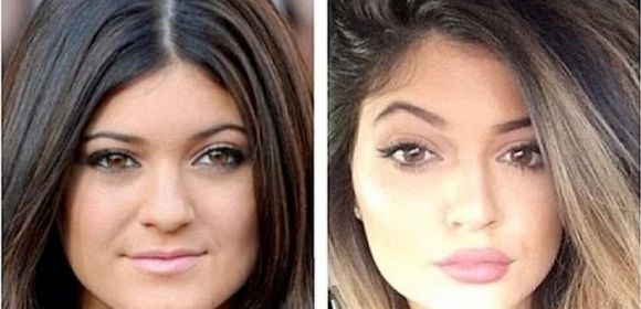 17-Year-Old Kylie Jenner Had Multiple Plastic Surgeries to Look like Kim Kardashian