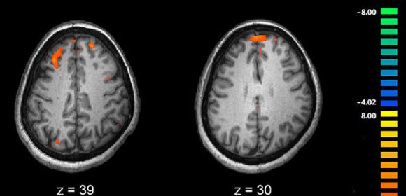 Changes in the Teen Brain Can Lead to Schizophrenia
