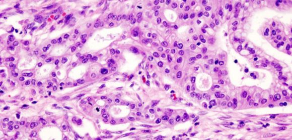 Combined Therapy Against Pancreatic Cancer Developed