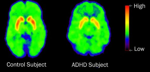 Genetic Underpinnings of ADHD Discovered