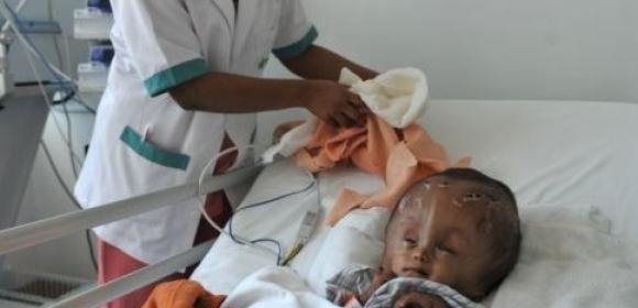 Girl Whose Skull Swelled to 3 Times Its Normal Size After Birth Undergoes Surgery