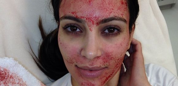 Kim Kardashian Gets Blood Facial – Video