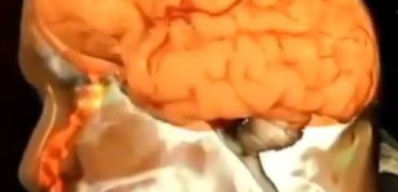 Man Keeps Leaking Brain Fluid Through His Nose for over a Year and a Half