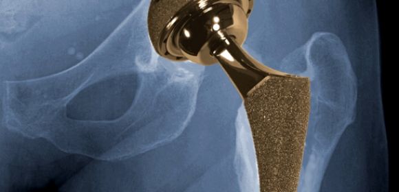 Metal-on-Metal Hip Implants Cause Soft Tissue Damage, FDA Says
