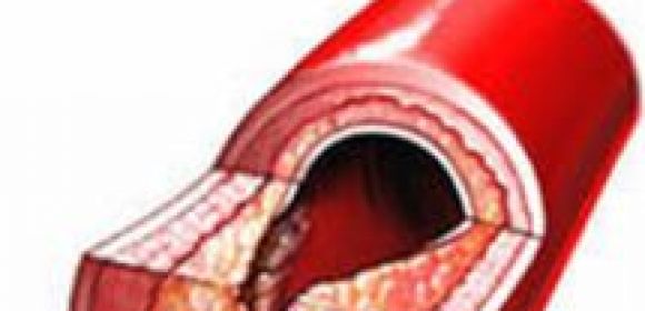 More and More Children Present Signs of Hardening and Narrowing of Arteries