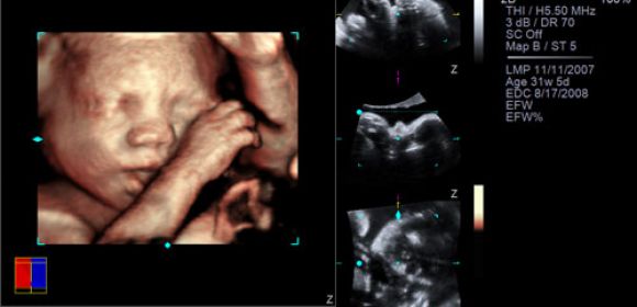NVIDIA 3D Vision Technology Enables 3D Viewing of Fetus