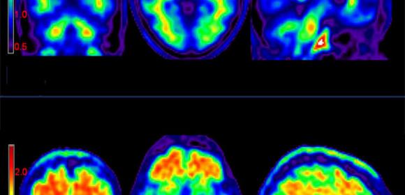 New Fluorescent Dye Detects Alzheimer's