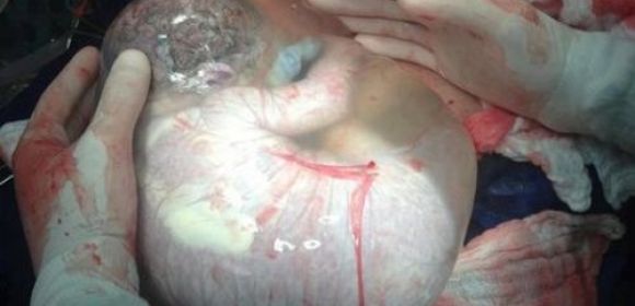 Picture of Baby Born in Its Amniotic Sac Goes Viral