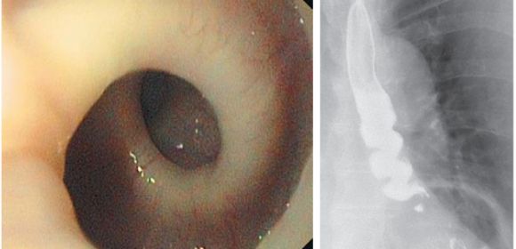 Spiraling Esophagus: Woman's Esophagus Turns Into a Corkscrew Whenever She Eats