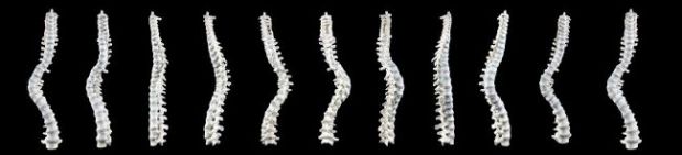 Scientists reveal what Richard III's spine looked like