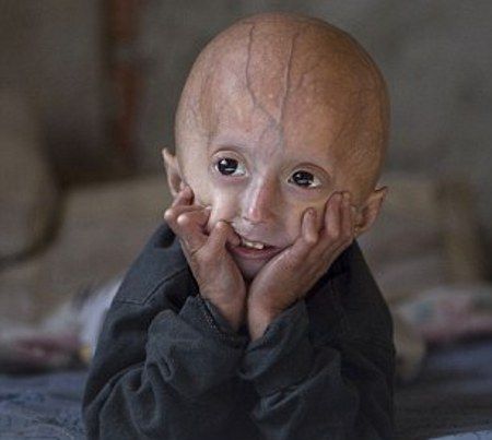 Most progeria sufferers die when about 13 years old