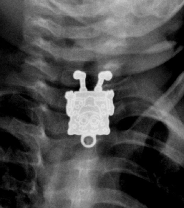 X-ray image shows the pendant swallowed by the toddler