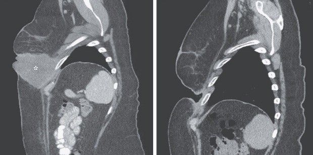 Scans show the tumor (left) and the hole left by it (right)