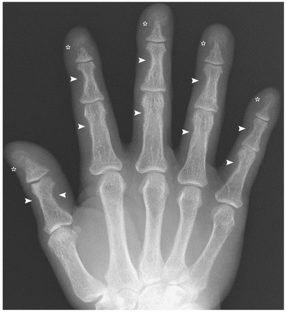 X-ray shows fingers bones affected by odd hormonal imbalance