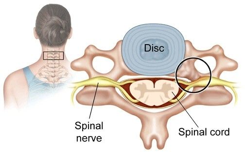 The problem zones in cervical spinal stenosis