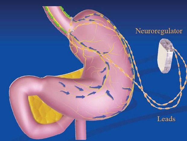 The device works by blocking communication between the brain and the stomach