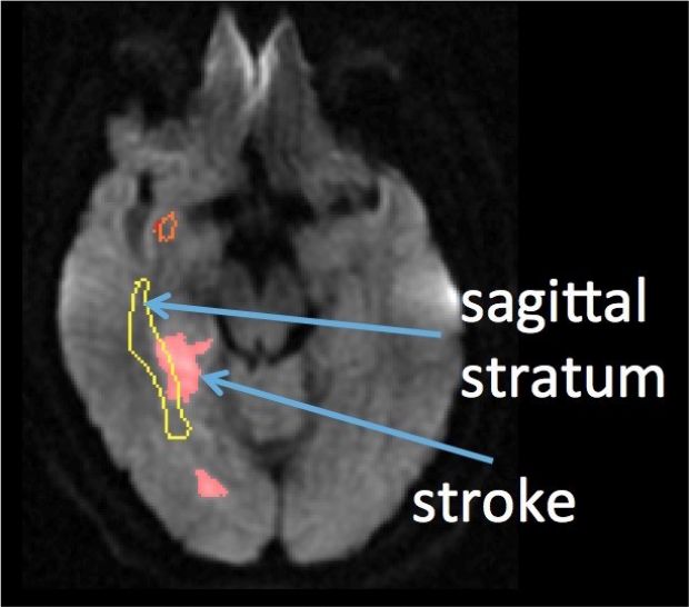Image shows the sagittal stratum