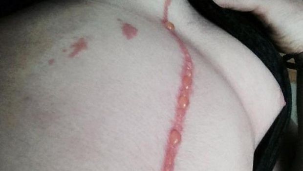 Photo shows the mark left by the spider on the man's body