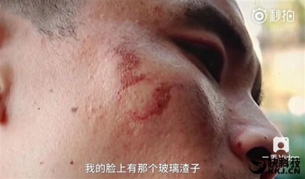 This is how the man's face looks after being hit with flying glass