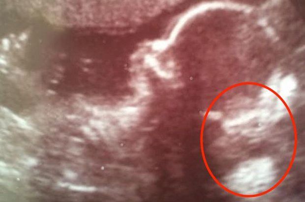 The baby scan (the supposed gremlin is circled in red)