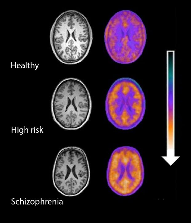 Immune activity (orange) in the brain of healthy individuals, people at risk of schizophrenia and schizophrenia patients