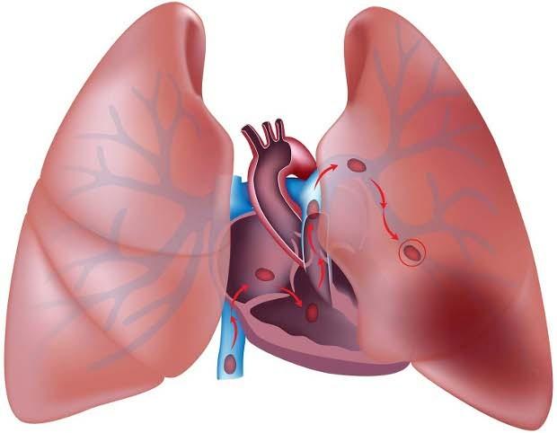 Pulmonary embolisms happen when blood clots block arteries in the lungs