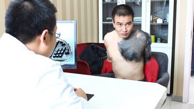 A Chinese man suffers from giant pigmented nevus