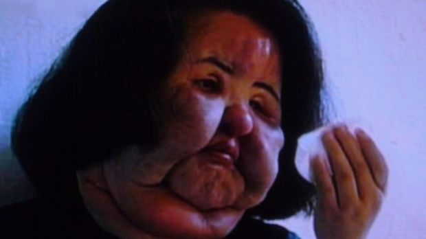 Hang Mioku injected herself with cooking oil in the face
