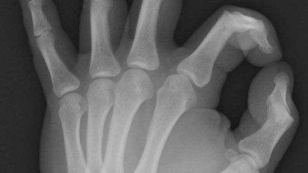 X-ray image of a human hand