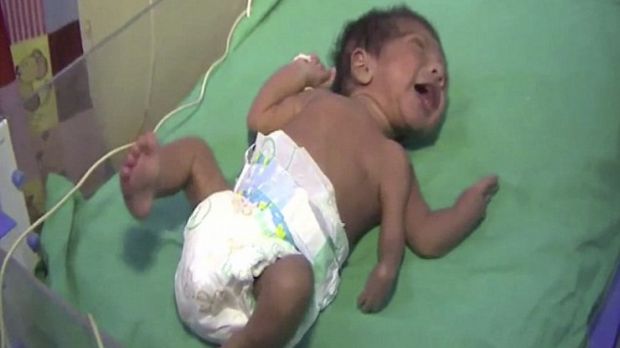 Doctors in India operate on baby boy born with 3 arms