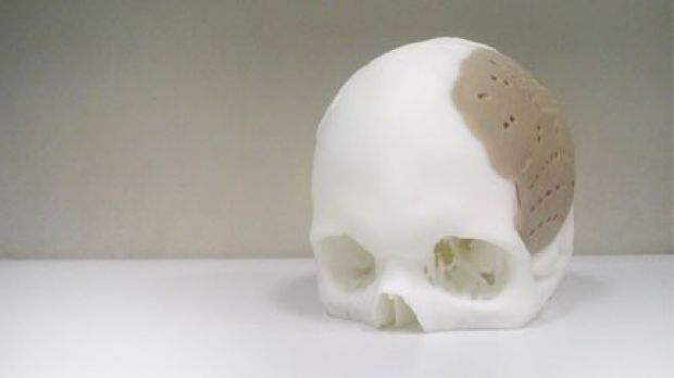 OPM skull implant