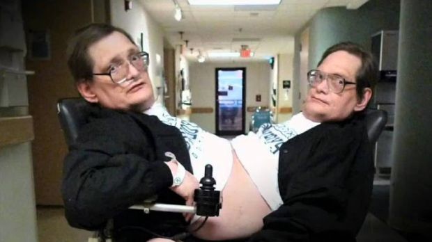 Introducing the world's oldest conjoined twins