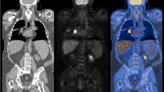 Scans showing lung cancer (bright spot in the chest). At left - CT scan; center - PET scan; right - combined CT-PET scan.