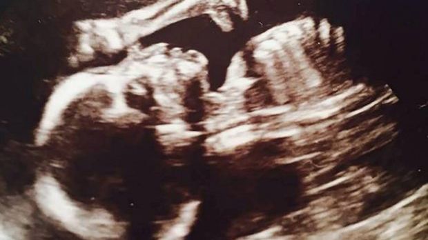 Dinosaur silhouette appears in baby scan