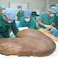 17-Stone (108-Kilogram) Tumor Successfully Removed from Man's Waist