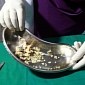232 Teeth Removed from 17-Year-Old Boy's Lower Jaw