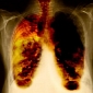 27-Year-Old Woman Dies After Being Transplanted Smoker's Lungs