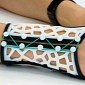 3D Printed Splints Will Treat Your Wrists While Looking Glamorous