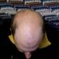 A Cure for Baldness Could Soon be Synthesized