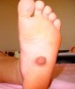 A Nipple on the Sole of the Foot!